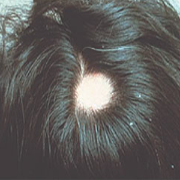 female hair loss