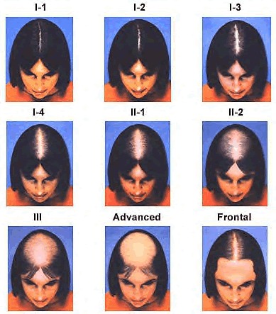 womens hair loss treatment