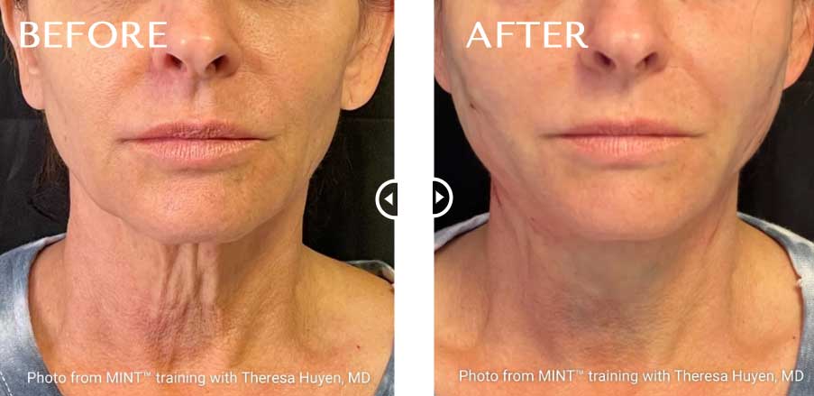 Thread Lift Before & After