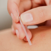 acupuncture Austin, TX
