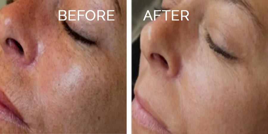 prx-before-after-1