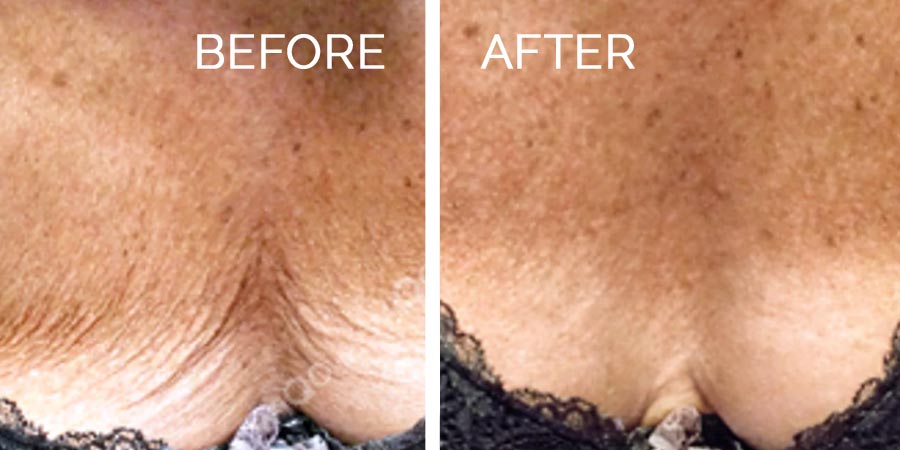 prx-before-after-2