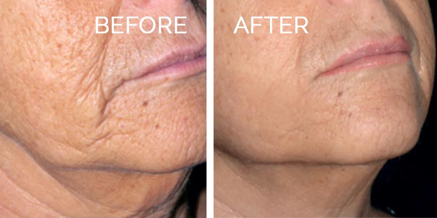 prx-before-after-3