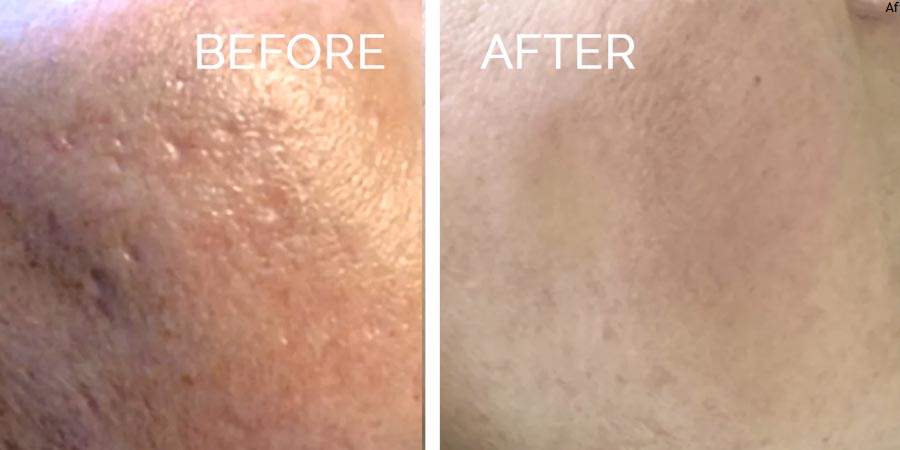 prx-before-after-4