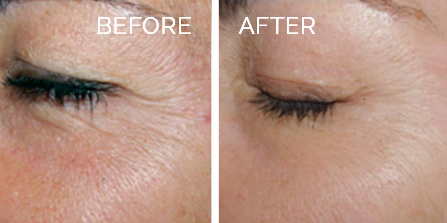 prx-before-after-5
