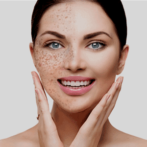 PRX melasma treatment PRX melasma treatment